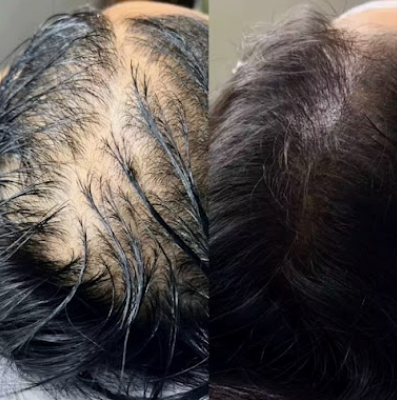 Antes y después de un tratamiento de salud capilar